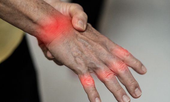 rheumatoid arthritis